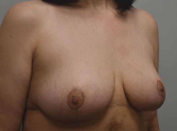 Breast Lift (Mastopexy): Case 244 - After