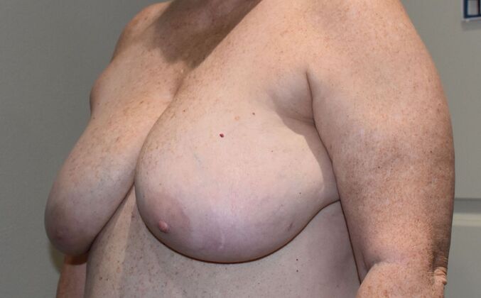 Breast Reduction: Case 198 - Before