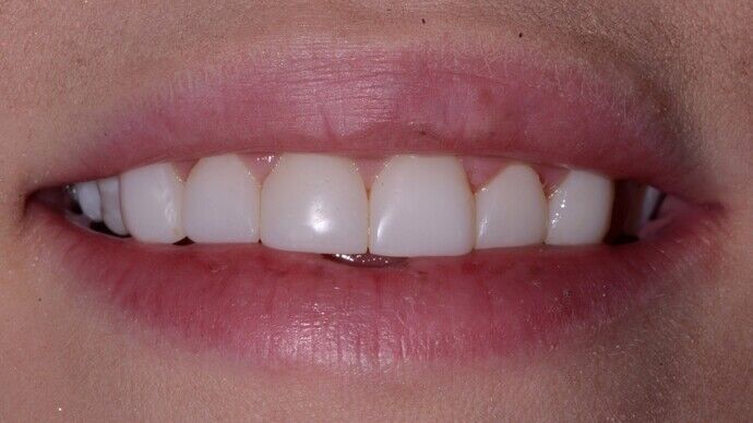Composite Veneers Cases