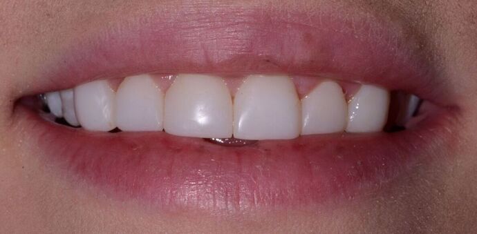 Composite Veneers  Composite Veneers to restore teeth with discoloration and wear - After