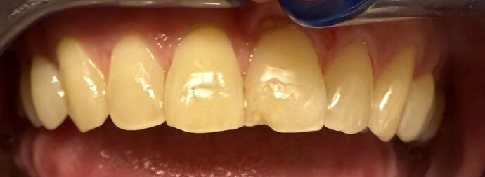Tooth-colored Fillings Case 1 - Before