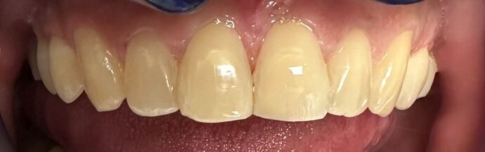 Tooth-colored Fillings Case 1 - After