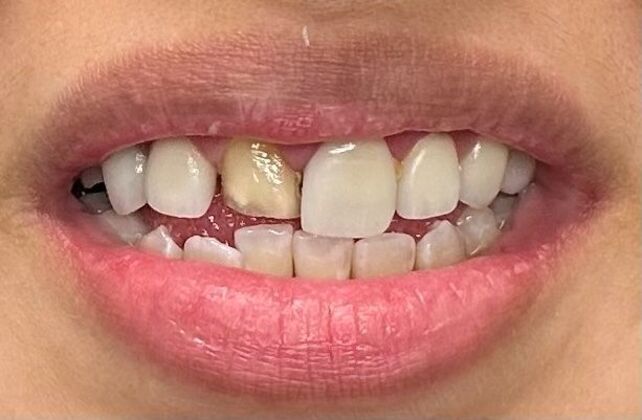 Crowns Case 1 - Before