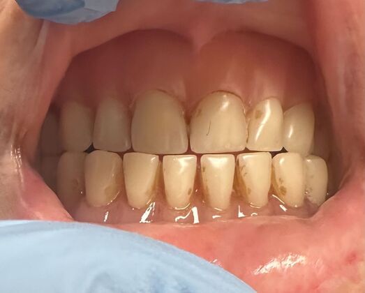 Dentures Case 1 - Before