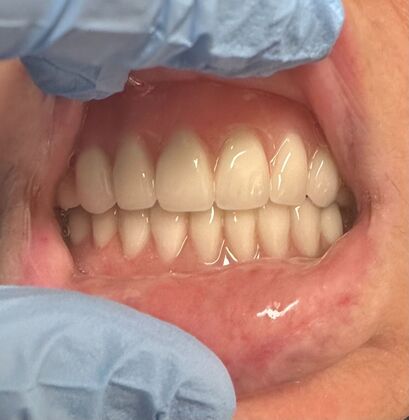 Dentures Case 1 - After