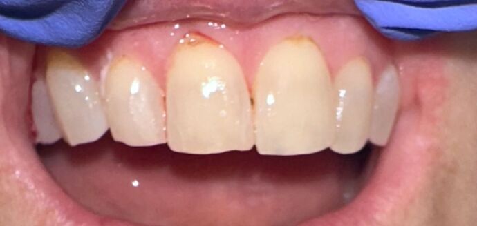 Tooth-colored Fillings Case 2 - Before