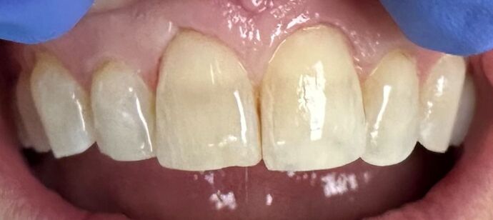 Tooth-colored Fillings Case 2 - After