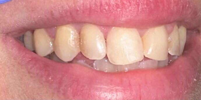 Tooth-colored Fillings Case 3 - After
