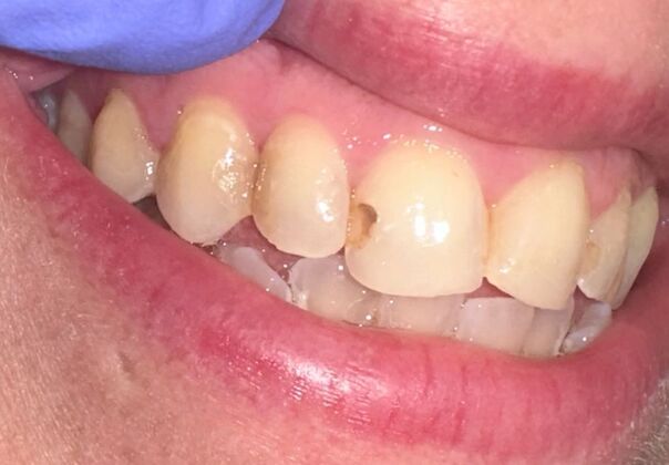 Tooth-colored Fillings Case 3 - Before