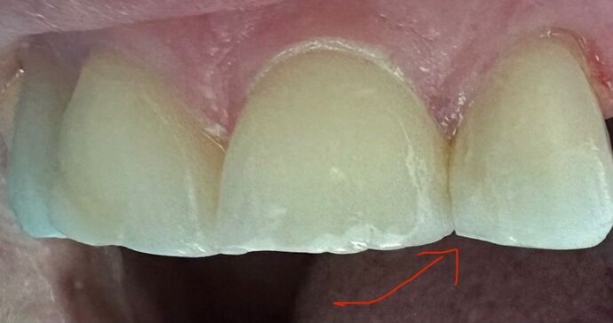 Tooth-colored Fillings Case 4 - After