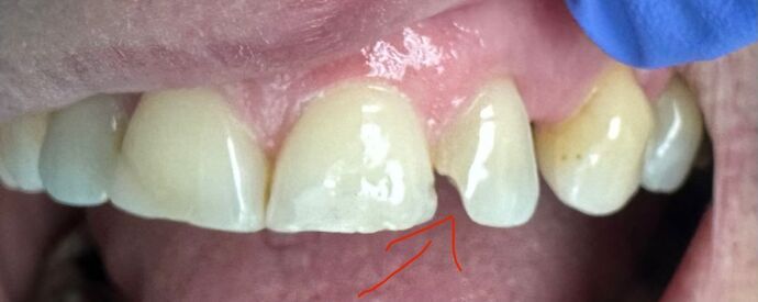 Tooth-colored Fillings Case 4 - Before