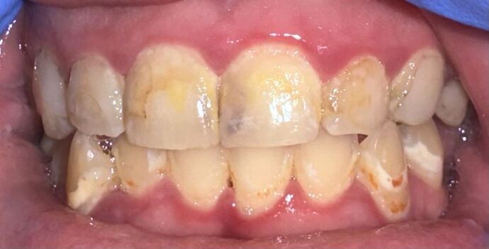 Crowns Case 2 - Before