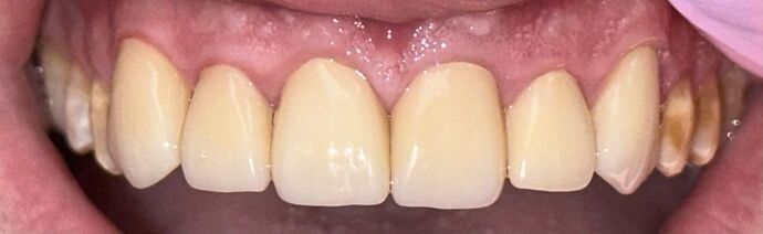 Crowns Case 2 - After
