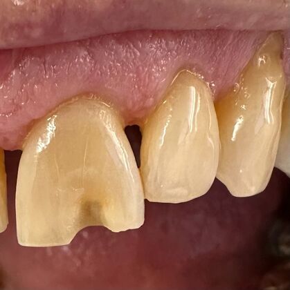 Cosmetic Bonding Case 1 - Before