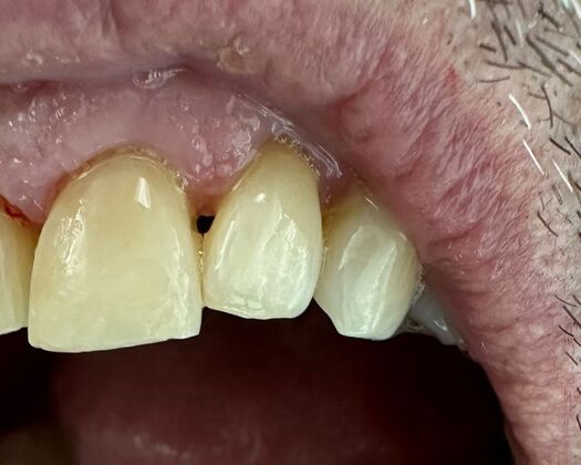 Cosmetic Bonding Case 1 - After