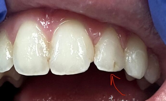 Tooth-colored Fillings Case 5 - Before