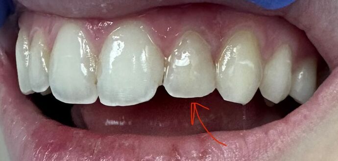 Tooth-colored Fillings Case 5 - After
