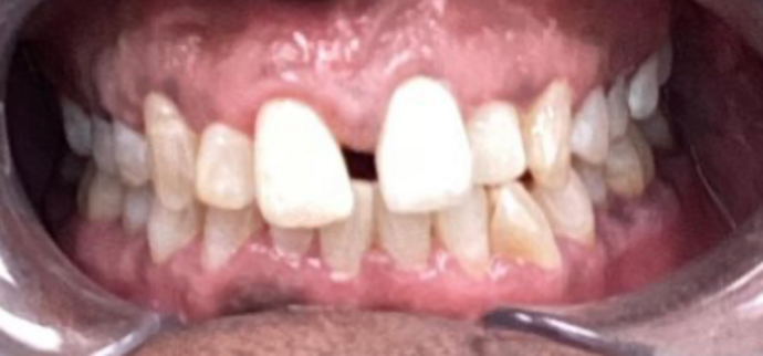 Invisalign Case 1 - Before