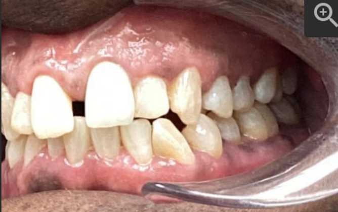 Invisalign: Case 1 - Before