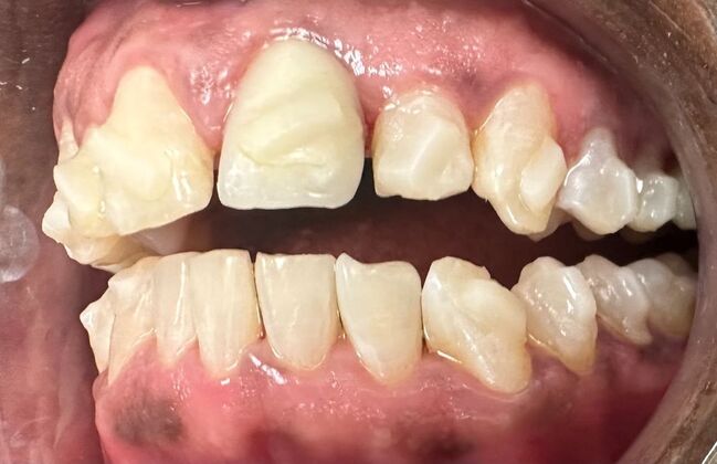 Invisalign: Case 1 - 5 Month Progress