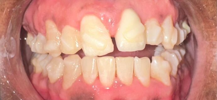 Invisalign Case 1 - After