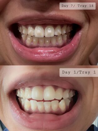 Invisalign Case 2