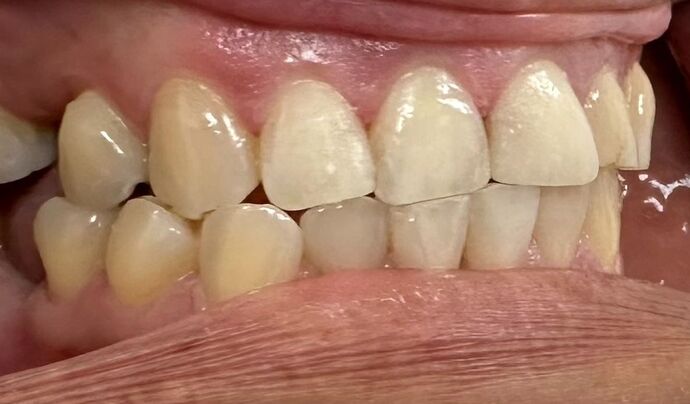 Tooth-colored Fillings Case 6 - After