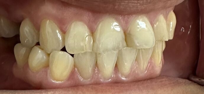 Tooth-colored Fillings Case 6 - Before