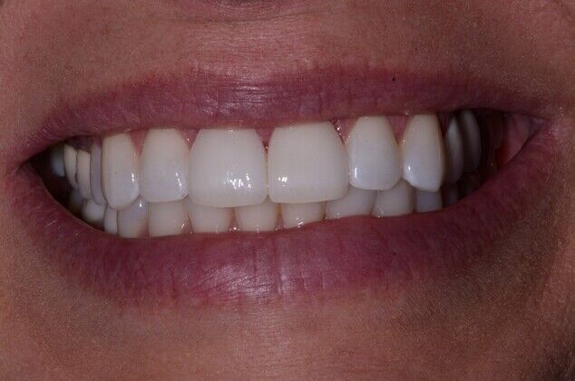 Porcelain Veneers Cases