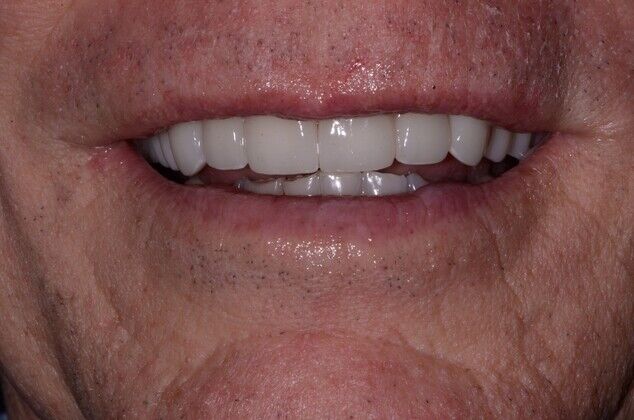 Porcelain Crowns Cases