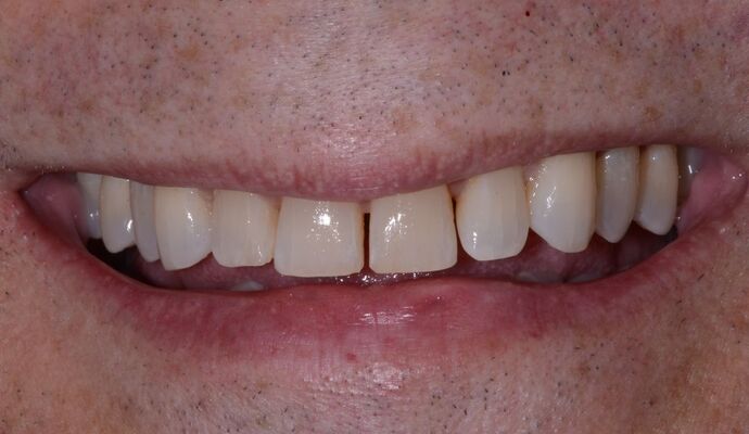 Composite Veneers  Composite Veneers in One Visit - Before