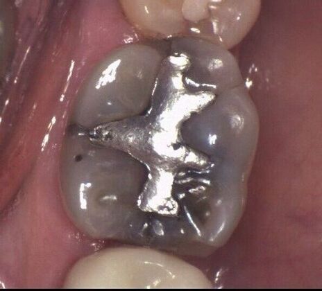 Porcelain Crowns Single Porcelain Crown Molar Tooth replaced in One Visit - Before