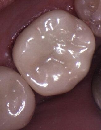 Porcelain Crowns Single Porcelain Crown Molar Tooth replaced in One Visit - After