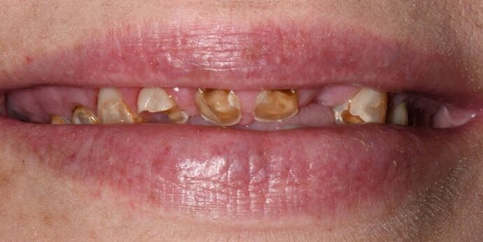 Malformed Smile & Missing Teeth: Full Mouth Reconstruction - Before