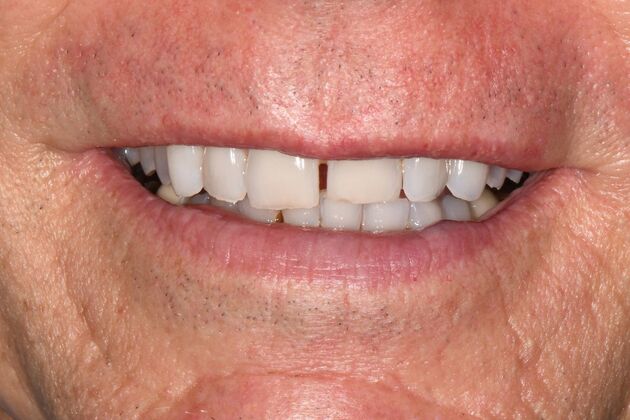 Malformed Smile & Missing Teeth: Broken and Worn Teeth with Failing Restorations - Before