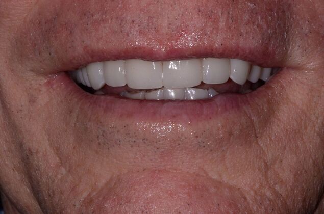Malformed Smile & Missing Teeth: Broken and Worn Teeth with Failing Restorations - After