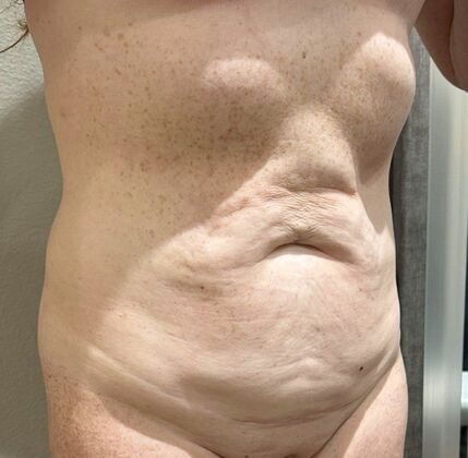Tummy Tuck (Abdominoplasty): Case 545 - Before