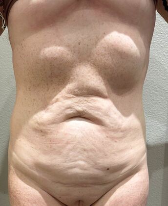 Tummy Tuck (Abdominoplasty): Case 545 - Before