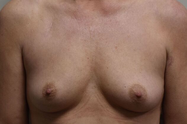 Breast Augmentation w/ Lift Case 608 - Before