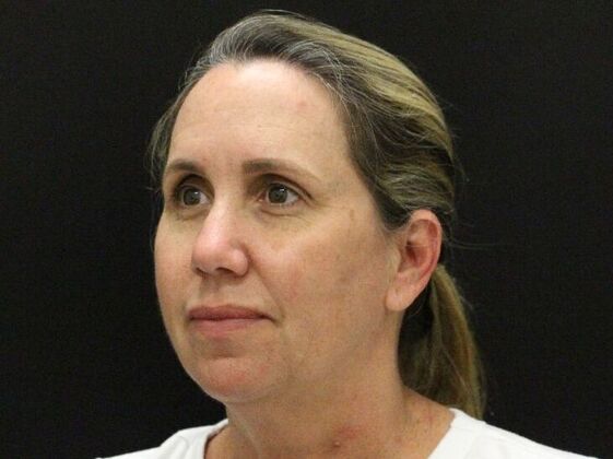 Face & Neck Lifts Case 56 - Before