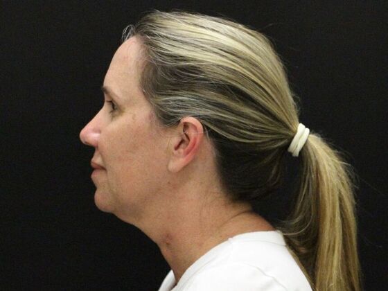 Face & Neck Lifts: Case 56 - Before