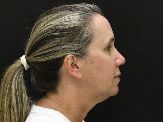 Face & Neck Lifts: Case 56 - Before
