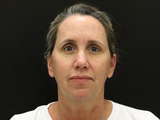 Face & Neck Lifts: Case 56 - Before