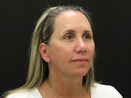 Face & Neck Lifts: Case 56 - After