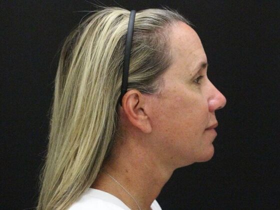 Face & Neck Lifts: Case 56 - After