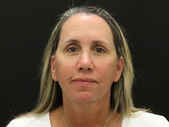 Face & Neck Lifts: Case 56 - After