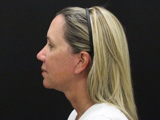 Face & Neck Lifts: Case 56 - After