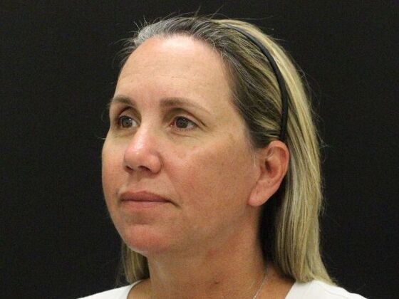 Face & Neck Lifts Case 56 - After