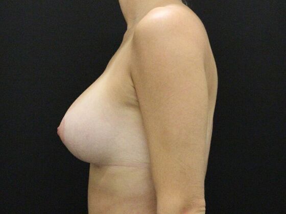 Breast Lift & Breast Lift Augmentation: Case 57 - After