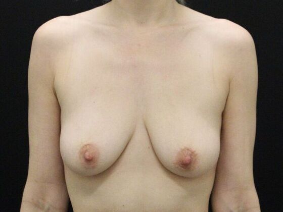 Breast Lift & Breast Lift Augmentation Case 57 - Before